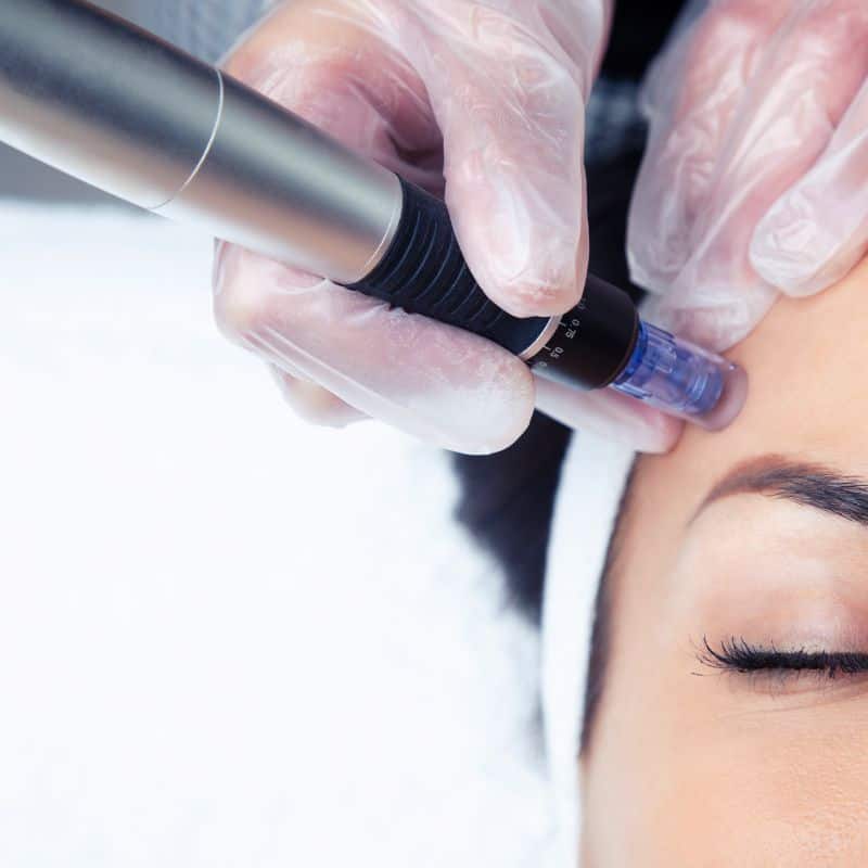 Morpheus8 treatment Princes Risborough from Lipo Sculpt - Book in today!